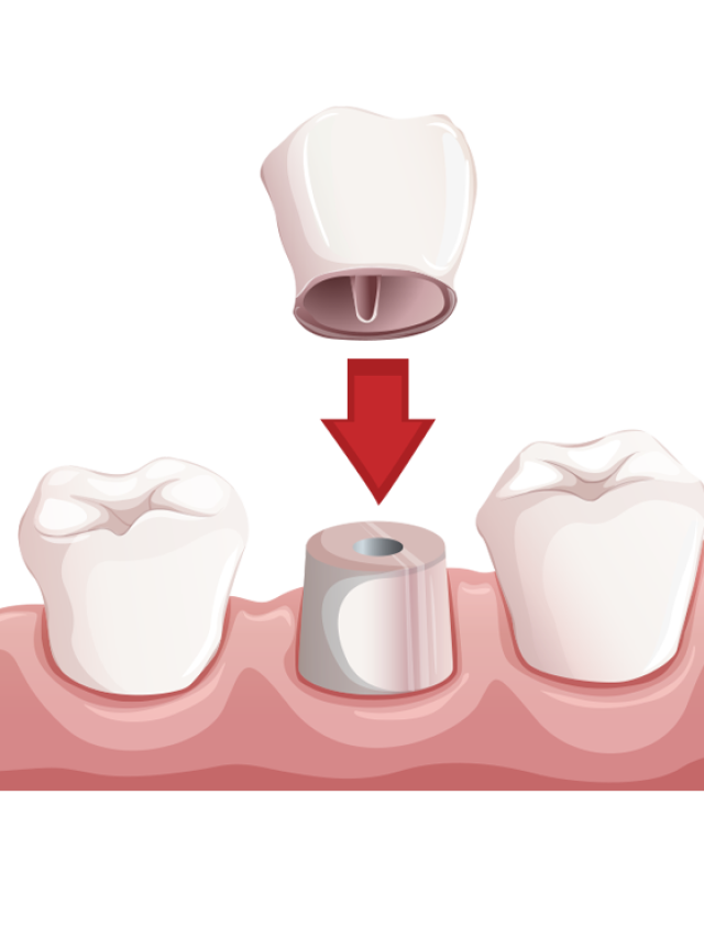 Cosmetic And Restorative Benefits Of Porcelain Crowns