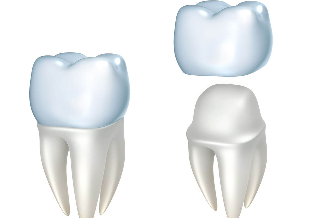 Dental Crowns for Teeth in Miles City MT Area