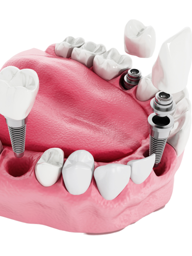 Did you know Dental Implants are disease prone, just like natural teeth?