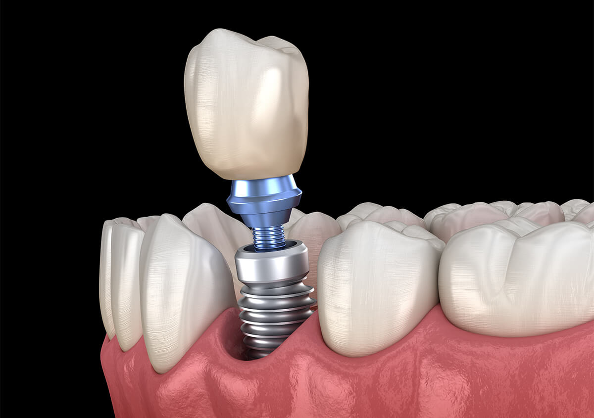 Natural Looking Dental Implants in Miles City MT Area